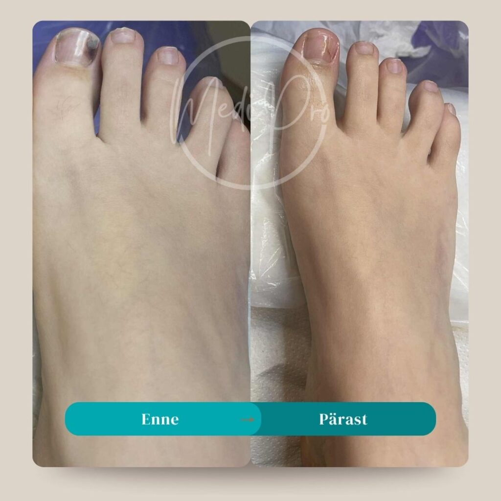 Ortootiline geel traumaküünele, küüne proteesimine