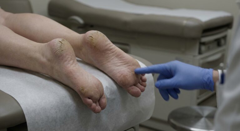 Kannalõhed: 4 sammu valuvabade jalgadeni kodustes tingimustes