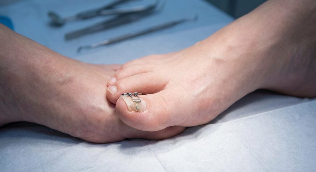 Varbaküüne klambrid: valutu alternatiiv kirurgiale