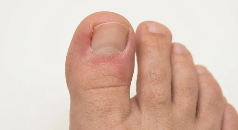 Kerge küünevalli põletik varbal